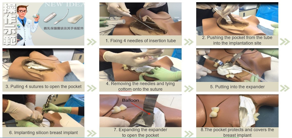 The application of Pocket Protector and surgical devices for capsular  contracture & Bone graft substitute